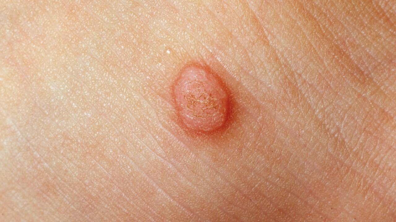 تفاوت بین گوشت و زگیل چیست؟