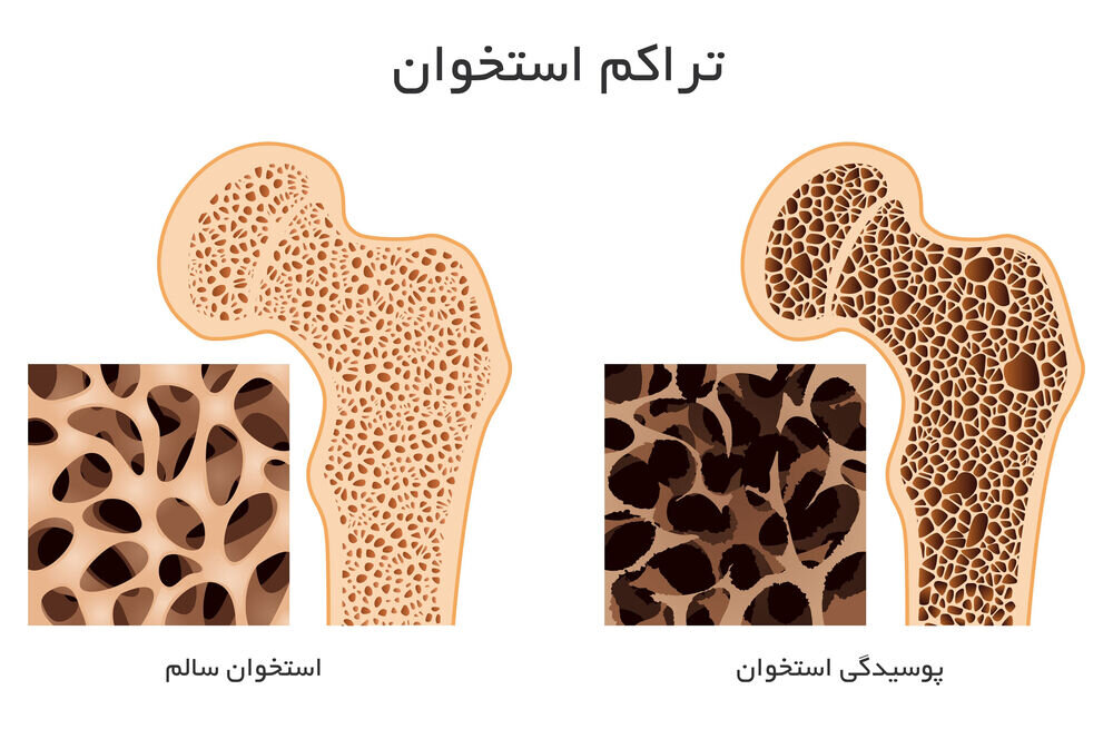 برای افزایش چگالی استخوان چه چیزی بخورید؟ 